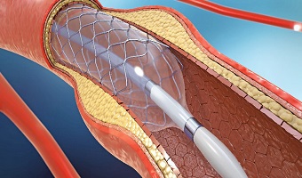 Angioplasty Pune